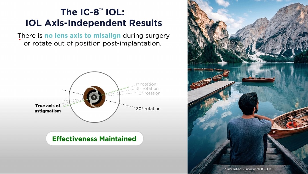 Alignment free astigmatism solution ic 8